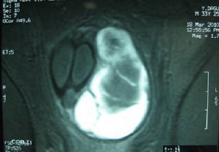 Fracture Penis – An atypical presentation
