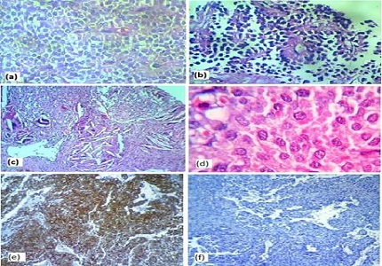 Solid pseudopapillary epithelial neoplasm: a rare cause of intractable abdominal pain in young women