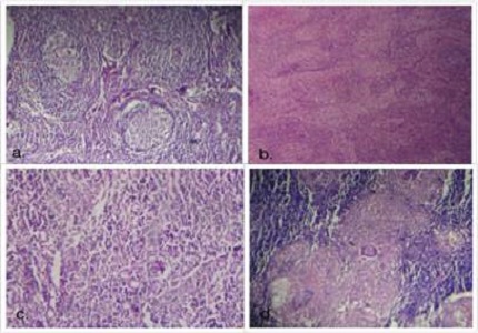 Histopathological and cytological spectrum of lymphadenopathy: a window to preliminary diagnosis