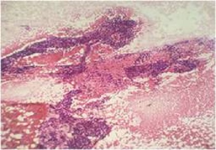 A study of aspiration cytology of various thyroid lesions and histopathological correlation
