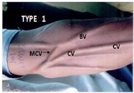 Variation in patterns of superficial vein of cubital fossa