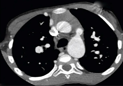 Unusual presentation of interrupted aortic arch: a case report and radiological review