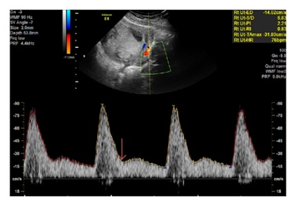 Color Doppler study of uterine vasculature in pregnancy induced hypertension