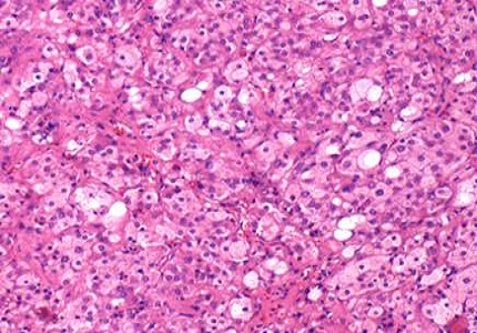 Pure leydig cell tumour – a rare virilizing tumour in a young female