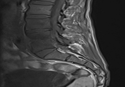 Spinal tuberculosis: imaging features on MRI