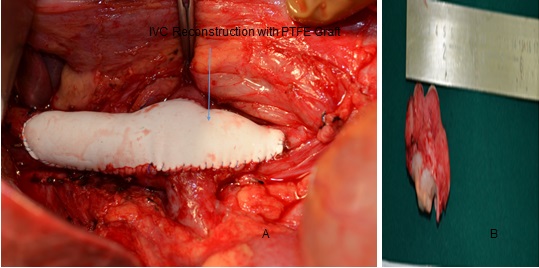 A Rare Case of Leiomyosarcoma of Inferior Vena Cava Managed with Curative Resection and PTFE Vascular Graft Reconstruction: A case report with review of literature