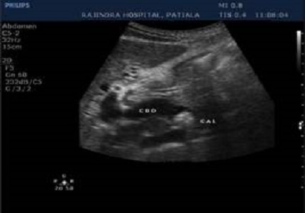 Comprehensive evaluation of MRCP versus ultra sonography in biliary obstruction