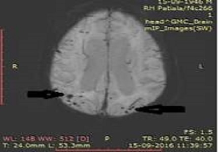 Cerebral amyloid angiopathy: A case report
