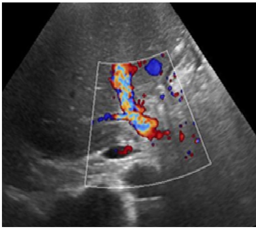 Contrast-enhanced ultrasound for the evaluation of hepatic artery occlusion after liver transplantation